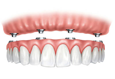 Ball-Retained Dentures in Oakley, CA