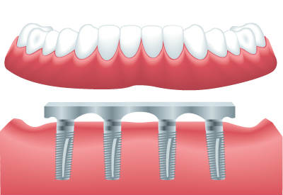 Bar-Retained Dentures in Oakley, CA