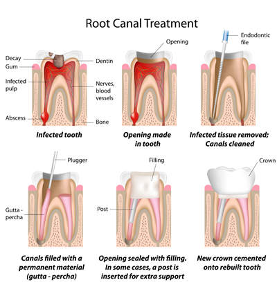 Root Canal Treatment in Oakley, CA