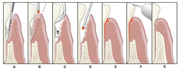 LANAP Laser Gum Surgery in Oakley, CA
