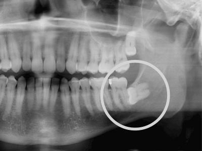 Wisdom Teeth in Oakley, CA