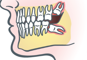 Wisdom Teeth Extraction in Oakley, CA